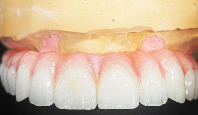 Picture of Trusana printed teeth