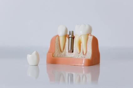 plastic model of a dental implant