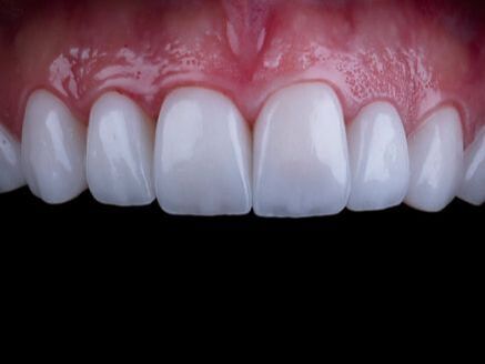 veneers vs. other dental treatments