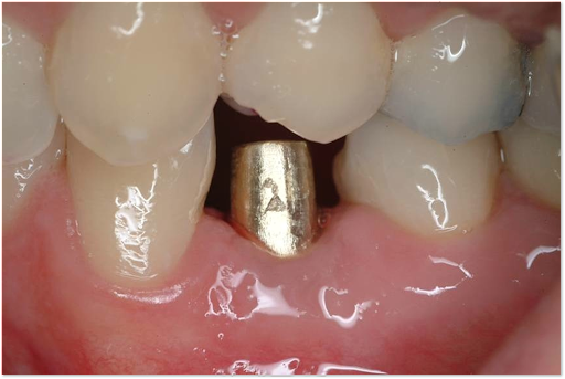 Picture of a placed abutment