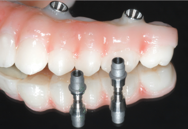 Screw-retained dentures