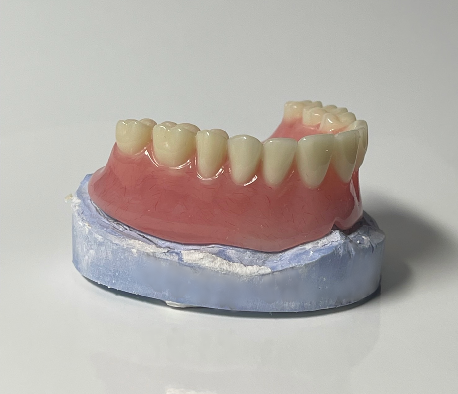 traditional vs digital dentures