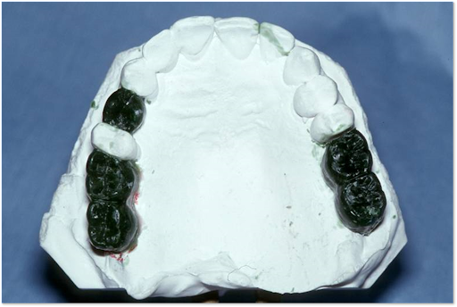 Picture of a Diagnostic wax up