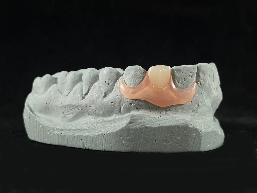 Dental nesbit partial denture