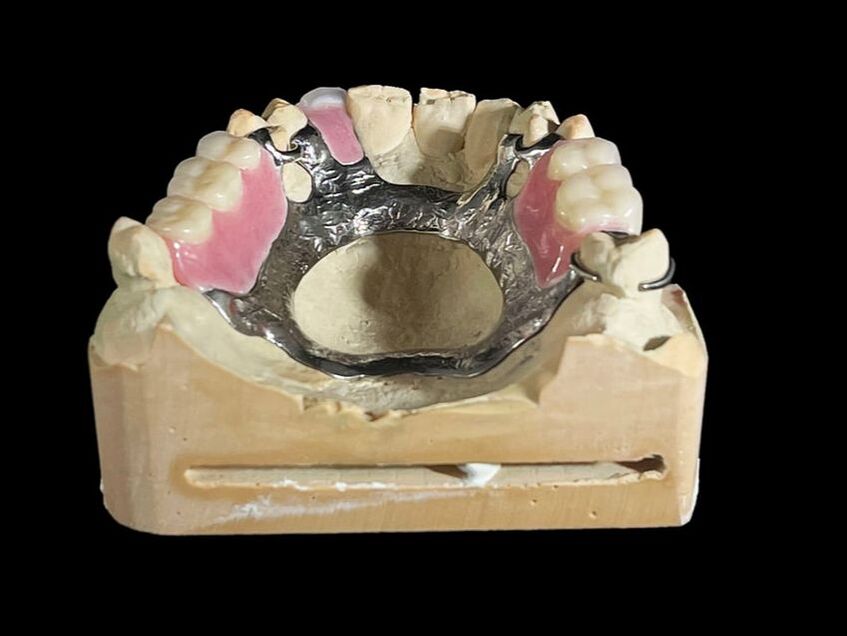 Cast metal partial dentures