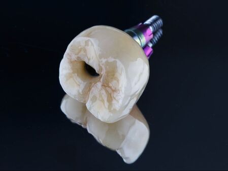 Picture of a screw-retained implant