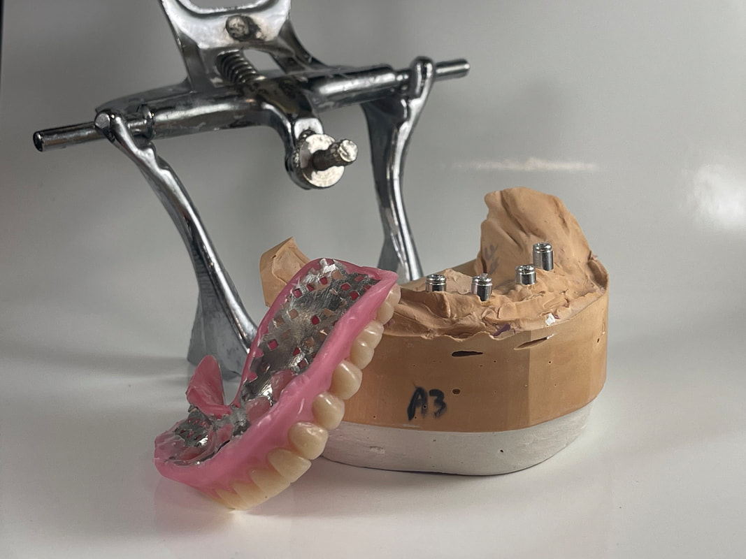 locator denture