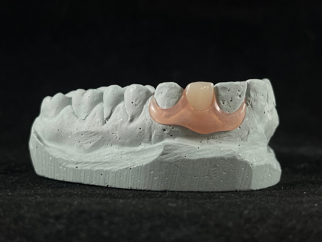 valplast flexible partial denture