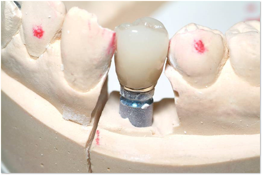 Picture of implant and abutment
