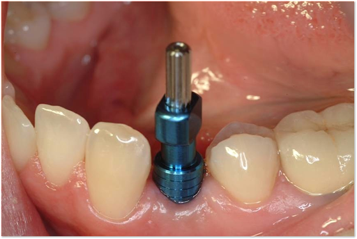 Picture of Dental Abutment