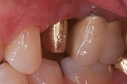 Picture of a dental implant