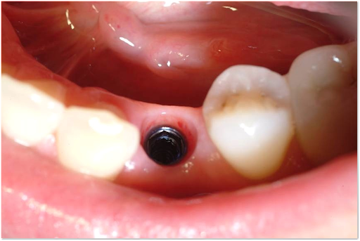 Space where dental implant will go