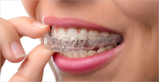 Picture of a woman putting in aligners