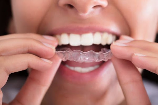 Picture of a woman putting aligners into her mouth