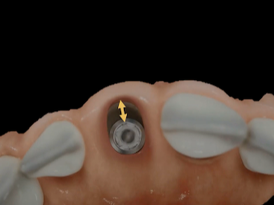 The intact facial bone wall between the buccal plate and implant should be greater than 1mm