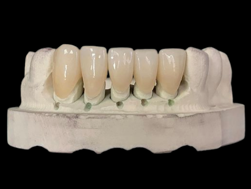 Dental crowns and bridges