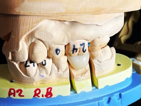 crown and bridge dental restorations