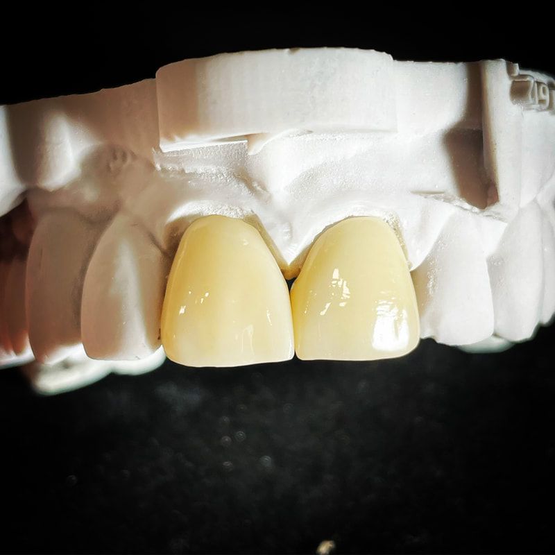 crown and bridge dental restorations