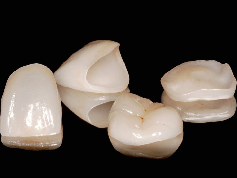 Picture of e.max crowns
