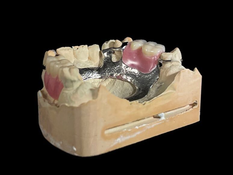 Cast Metal partial denture