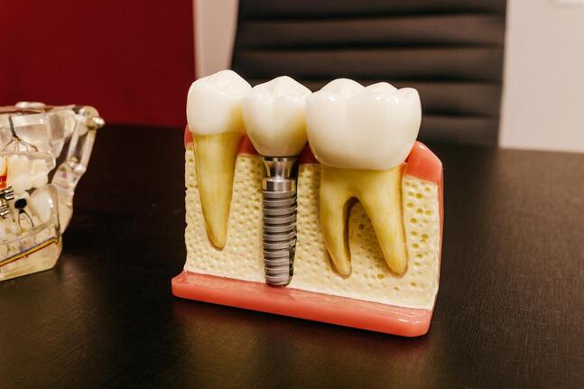 Picture of a dental implant model
