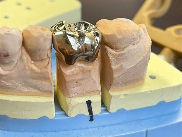 crown and bridge dental restoration