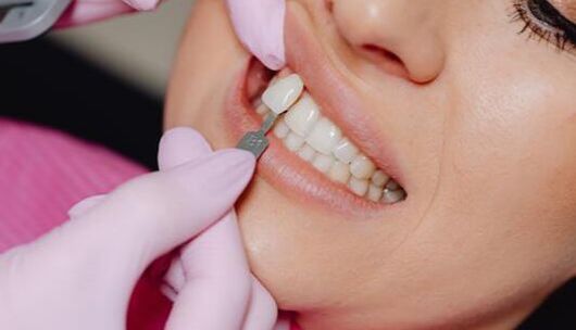Picture of a patient getting veneers