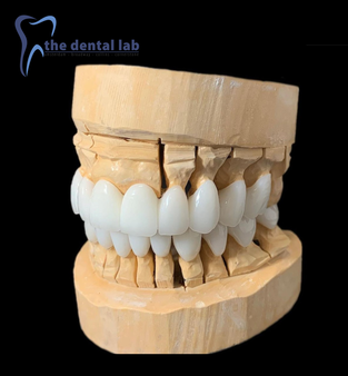 Picture of Porcelain crown and veneers