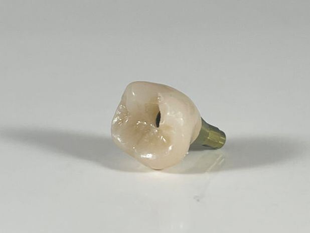 screw retained implant crown
