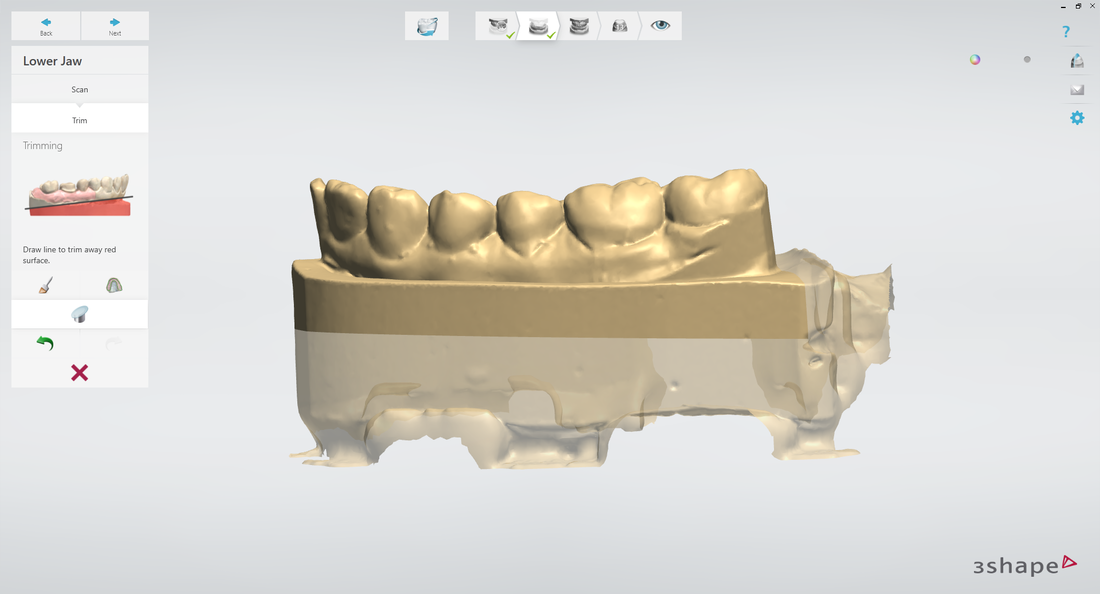 Dental scan on CAD/CAM software