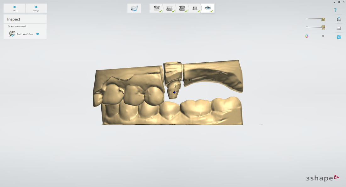 3D Dental Scan on CAD/CAM software