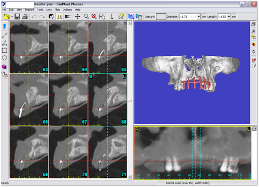 Picture of Surgical guide in CAD/CAM software